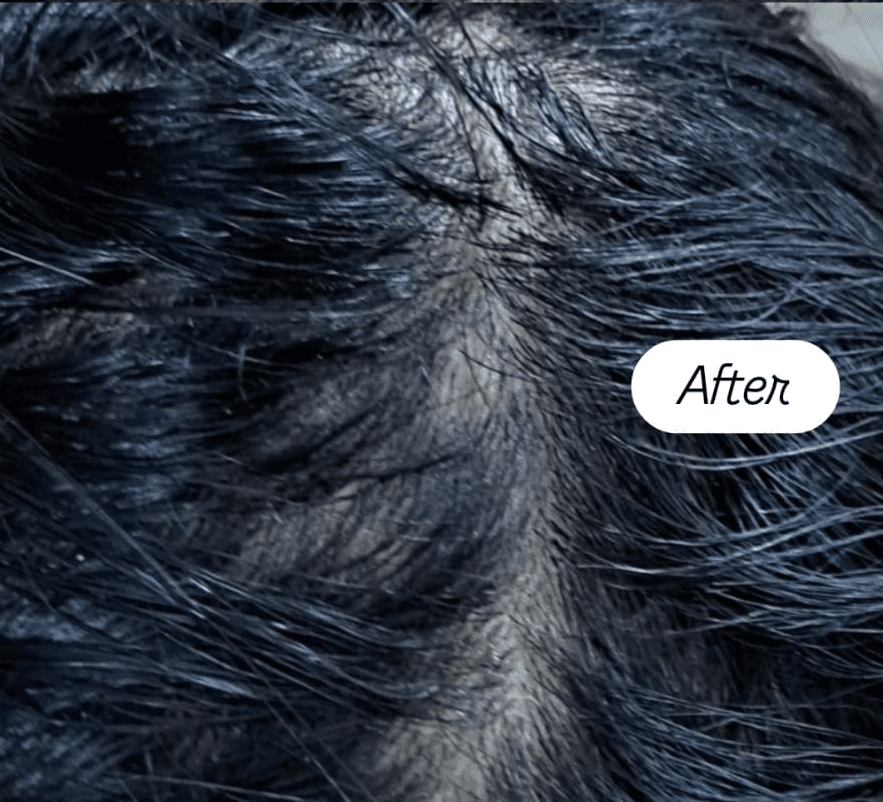 Skin Rejuvenation after treatment